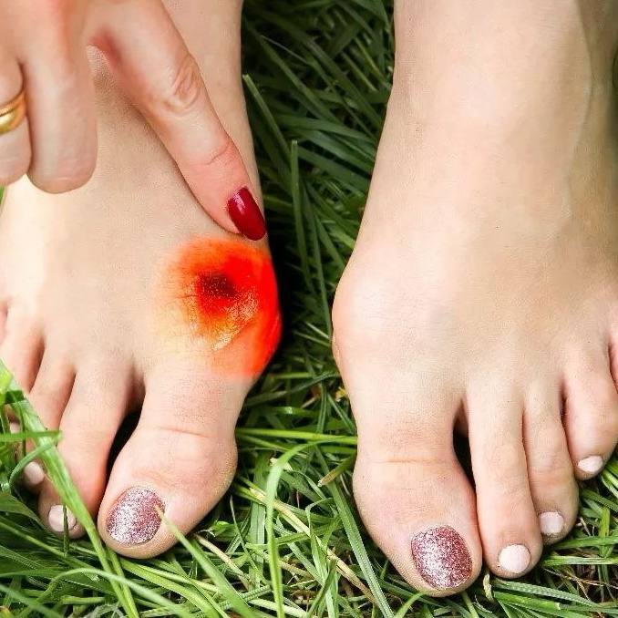 WHAT CAUCES THE GROWTH OF THE BONE ON THE FOOT